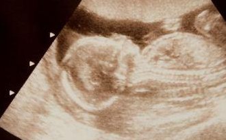 无卵巢可以试管助孕吗？步骤是怎样的？